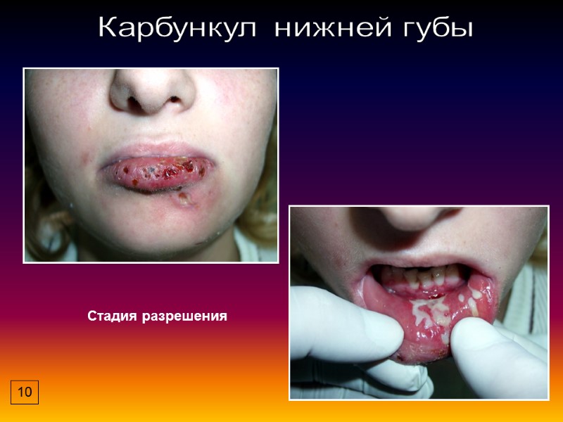 Карбункул нижней губы Стадия разрешения 10